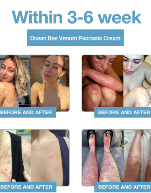 Bee Venom &Ocean Psoriasis Healing Cream ( Pack Of 1 )
