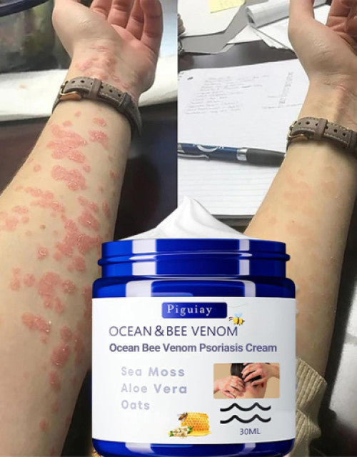 Bee Venom &Ocean Psoriasis Healing Cream ( Pack Of 1 )