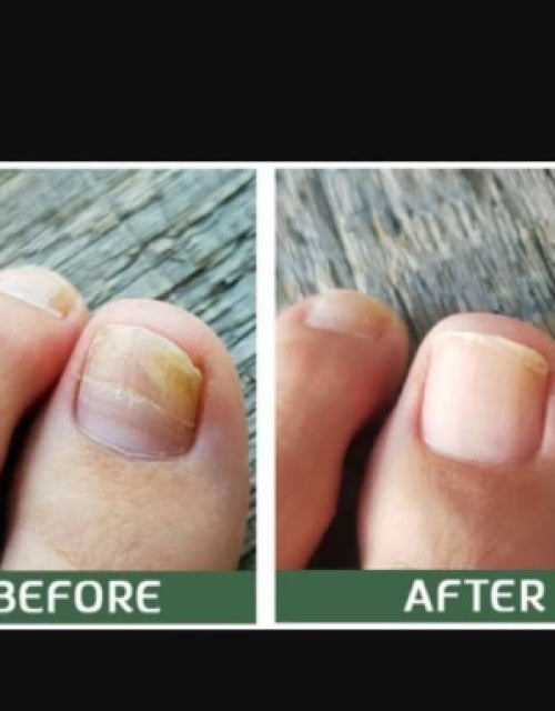 BeeVenom Nail Fungus Solution 15ml Each (Pack of 2)